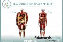 Sobrepeso y artrosis