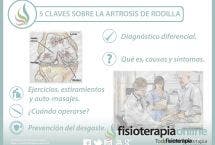 5 claves sobre la artrosis de rodilla