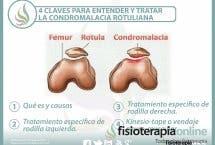 4 claves para entender y tratar la condromalacia rotuliana