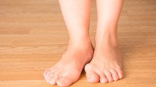 Hallux valgus o Juanetes. Qué es, causas, síntomas y tratamiento Hallux valgus o Juanetes. Qué es, causas, síntomas y tratamiento