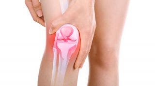 ¿Qué es una bursitis de rodilla? Causas, diagnóstico y tratamiento en fisioterapia y medicina ¿Qué es una bursitis de rodilla? Causas, diagnóstico y tratamiento en fisioterapia y medicina