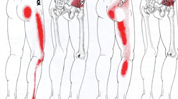 Puntos Gatillos Miofaciales en el miembro inferior. ¿De qué estamos hablando?