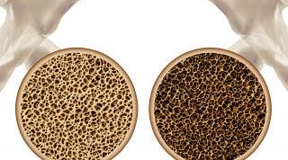 Osteoporosis: Causas, síntomas y tratamiento dietético y nutricional Osteoporosis: Causas, síntomas y tratamiento dietético y nutricional
