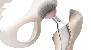 Prótesis de cadera. Consejos y rehabilitación.