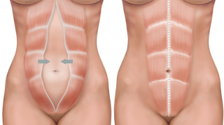 Embarazo: diástasis de los músculos rectos. Generalidades, prevención y tratamiento