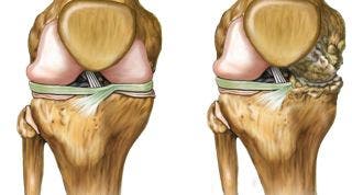 Artrosis en el deporte ¿Cómo cuidar nuestra rodilla? Prevención, tratamiento, alimentación y suplementos Artrosis en el deporte ¿Cómo cuidar nuestra rodilla? Prevención, tratamiento, alimentación y suplementos