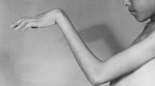 Automasajes y estiramientos en caso de Síndrome o Contractura de Volkmann