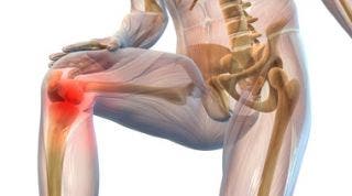 Tratamiento fisioterápico de la gonartrosis o artrosis de rodilla