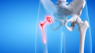Cirugía de Protesis de cadera, Cómo se realiza la operación y cómo es su rehabilitación