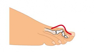 Los dedos en martillo. Sus causas, síntomas y tratamiento