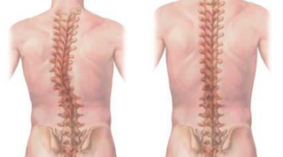 Escoliosis y yoga: Síntomas. Diagnóstico. ¿Cómo ayuda la práctica del Yoga? Recomendaciones prácticas.(1ra parte)