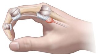 Dedo en gatillo o en resorte. Qué es, causas, síntomas y tratamiento en fisioterapia