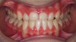 Cómo influye la mordida y la mandíbula en tu postura corporal y tu dolor de espalda