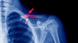 ¿Cómo cuidar la fractura de clavícula?