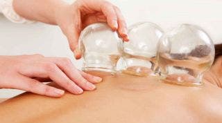 ¿En qué consiste la terapia con ventosas? ¿En qué consiste la terapia con ventosas?