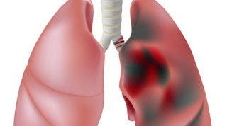 Enfermedad pulmonar obstructiva cronica o EPOC ¿Qué es?