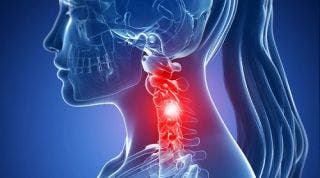 ¿Qué puedo hacer si tengo espondilosis cervical?