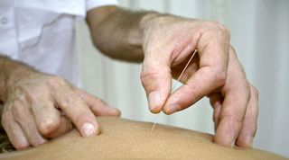 La punción seca en la epicondilitis o dolor epicondileo