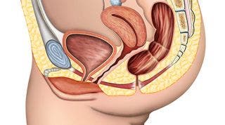 ¿Qué es la Incontinencia urinaria? ¿Cómo se trata?