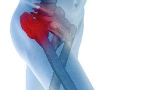 Artrosis de cadera o coxartrosis. Síntomas, Diagnóstico y tratamiento de fisioterapia.