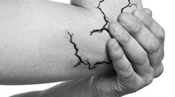 Tratamiento para la epicondilitis o codo de tenista