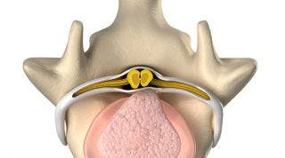 ¿Qué es una Hernia Discal? Causas y síntomas