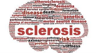 Clasificación de la esclerosis múltiple