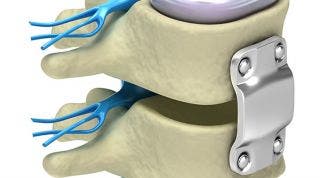 Artrodesis lumbar: Qué es, indicaciones, riesgos y tratamiento de fisioterapia.