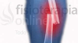 Proceso de curación de las Fracturas y Retardo de la Consolidación