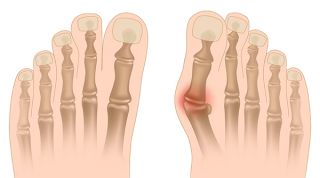 ¿Qué es un Juanete o Hallux Valgus?
