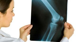 Artrosis o desgaste de rodilla. 5 consejos de un fisioterapeuta