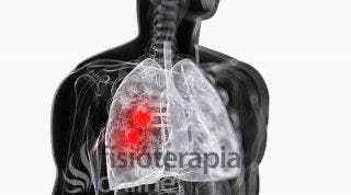 ¿Qué es un Absceso Pulmonar?