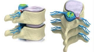 Hernias discales.