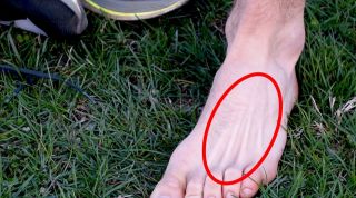 Fractura por estrés del metatarsiano: ¿Qué es? ¿Cuál es su tratamiento? ¿Qué hacer?