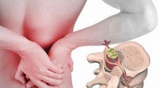 Hernia discal derecha. A propósito de un caso clínico Hernia discal derecha. A propósito de un caso clínico