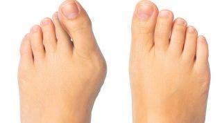 Cómo tratar el Hallux Valgus o Juanete: ejercicios, automasajes y vendaje