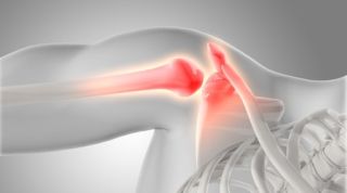 Bursitis, Tendinitis y Síndrome Subacromial: ¿Cómo Diferenciarlos y Tratarlos Correctamente?