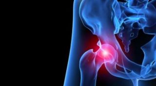 ¿Cuáles son las claves que permiten el diagnóstico del pinzamiento femoroacetabular?