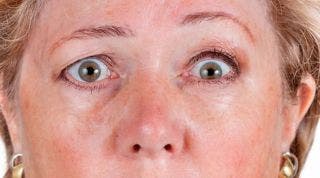 ¿Qué es una Ptosis palpebral? Causas, síntomas y tratamiento fisioterapéutico