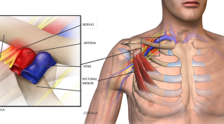 Síndrome del Desfiladero Torácico: qué es, tipos, causas, diagnóstico y tratamiento