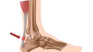 Rotura del tendón de Aquiles. Causas, síntomas y tratamiento
