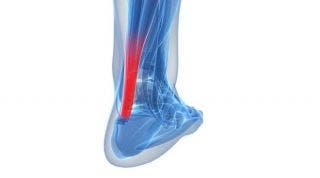 Falsa tendinitis del tendón de Aquiles (Tendinitis del tibial posterior) Falsa tendinitis del tendón de Aquiles (Tendinitis del tibial posterior)