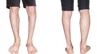 ¿Tienes una pierna más corta? Compensaciones musculares y cómo corregirlas