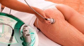Tratamiento de la “celulitis” con radiofrecuencia Tratamiento de la “celulitis” con radiofrecuencia