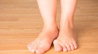 Hallux valgus o Juanetes. Qué es, causas, síntomas y tratamiento