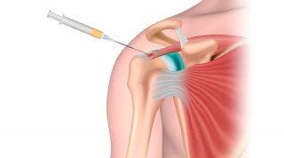 Beneficios del plasma rico en plaquetas en lesiones articulares, indicaciones, contraindicaciones y efectos terapéuticos