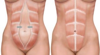 Diástasis de los rectos abdominales. Qué es y consejos para su cuidado