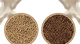Osteoporosis: Causas, síntomas y tratamiento dietético y nutricional Osteoporosis: Causas, síntomas y tratamiento dietético y nutricional