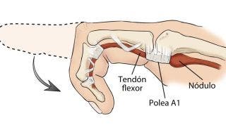 Cirugía de Dedo en gatillo o resorte, Cómo se realiza la operación y cómo es su rehabilitación