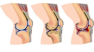 Artrosis o desgaste articular. Qué es, causas, síntomas y tratamiento quirúrgico y de fisioterapia